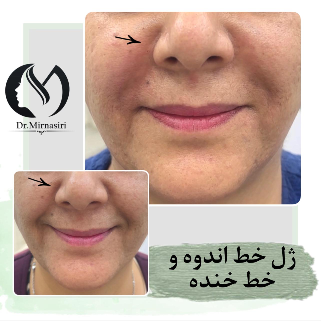 ژل خط اندوه و خط  خنده