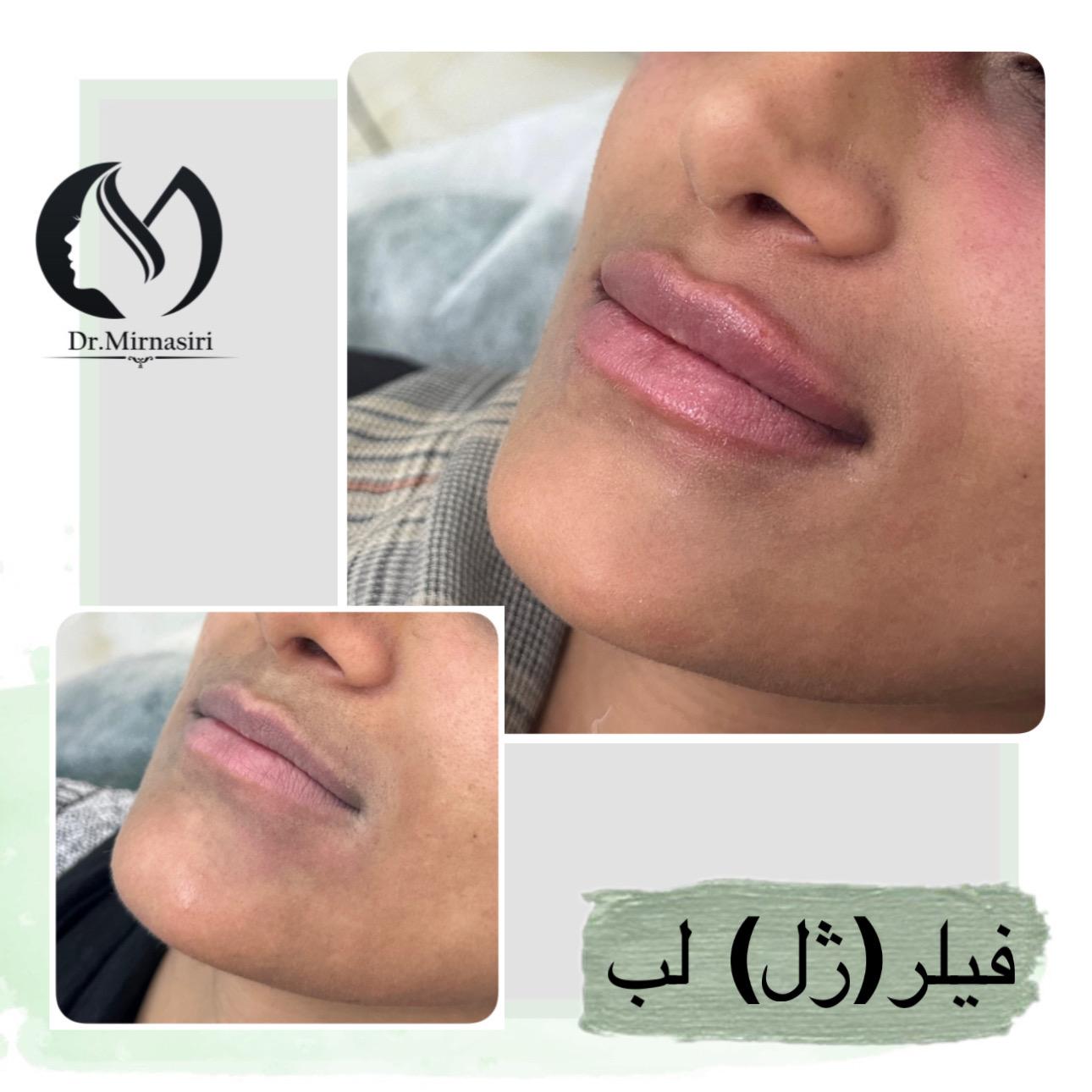 فیلر (ژل) لب