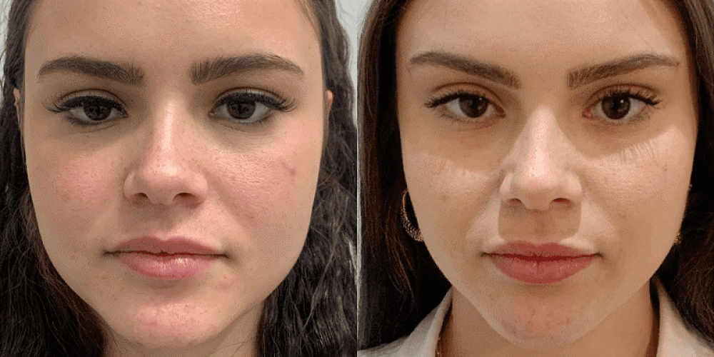 معجزه لیفت با نخ در درمان افتادگی صورت با دکتر منیرالسادات میرنصیری